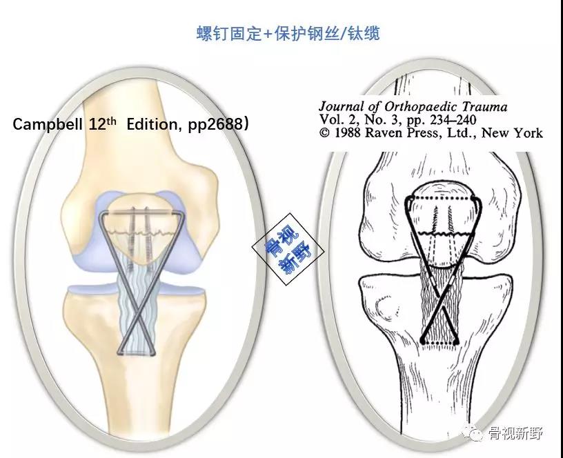 图解:秒懂髌骨下极撕脱骨折的保护钢丝/钛缆