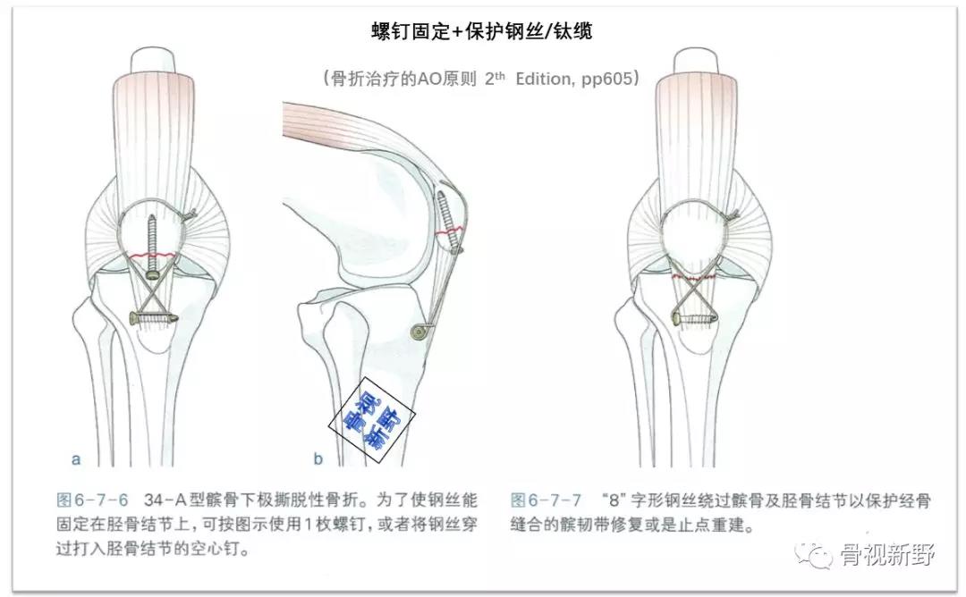 图解:秒懂髌骨下极撕脱骨折的保护钢丝/钛缆