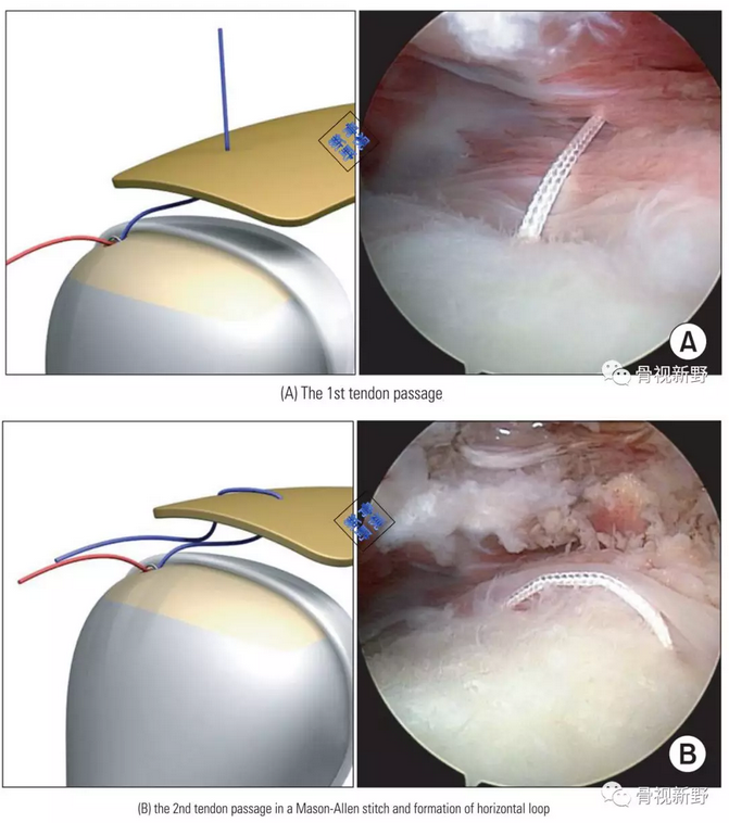 图解:改良的mason-allen桥式缝合技术