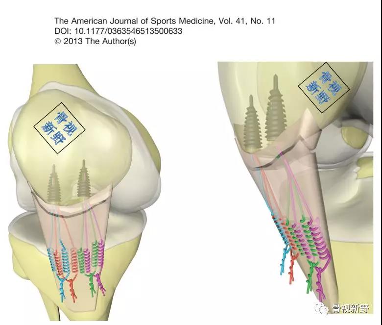 髌韧带撕脱的krackow及其改良缝合方法