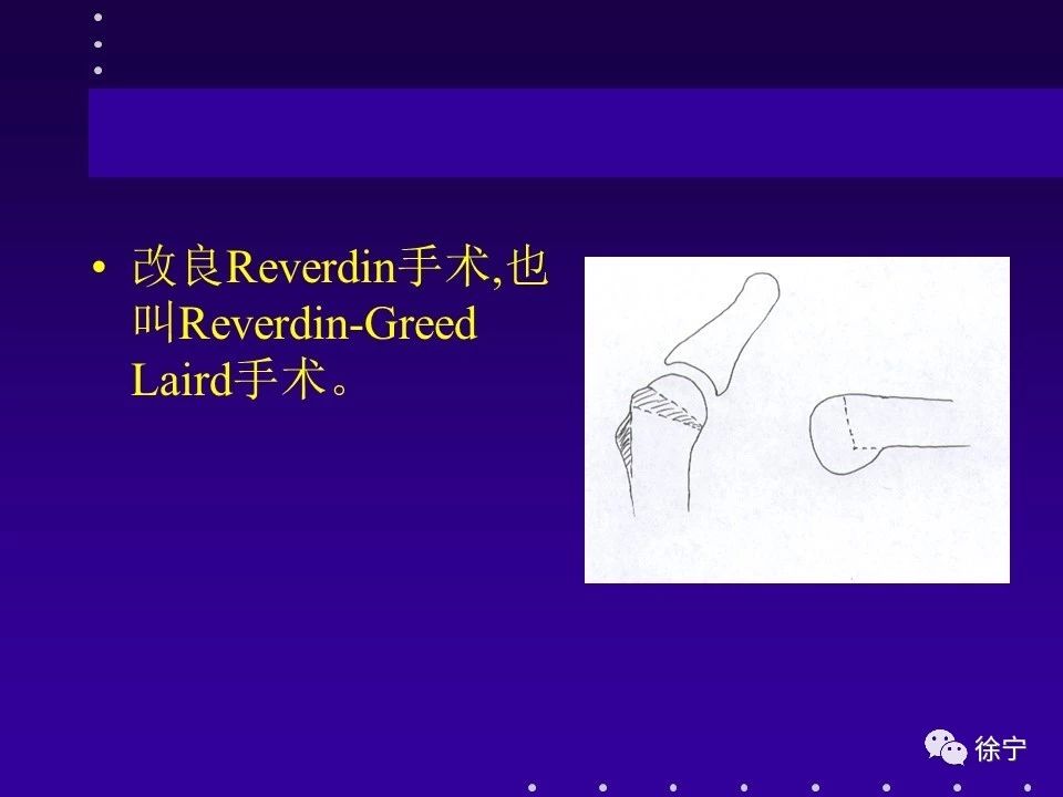 [2] 王之宇,林格生,改良mcbride 术联合第1 跖骨截骨治疗拇外翻,中国