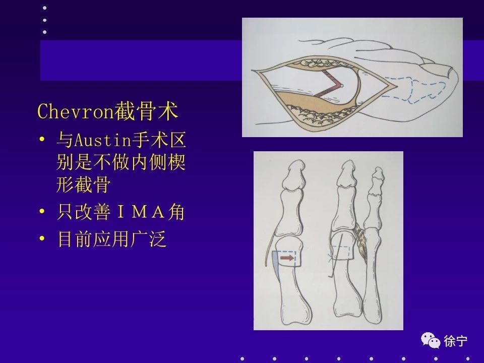 [3] 黄加张,akin 截骨术在拇外翻手术应用的探讨,中国骨与关节外科