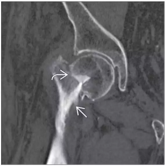 冠状位重建骨ct 示一嵌插错位的股骨头下型股骨颈骨折,有几乎完全错位