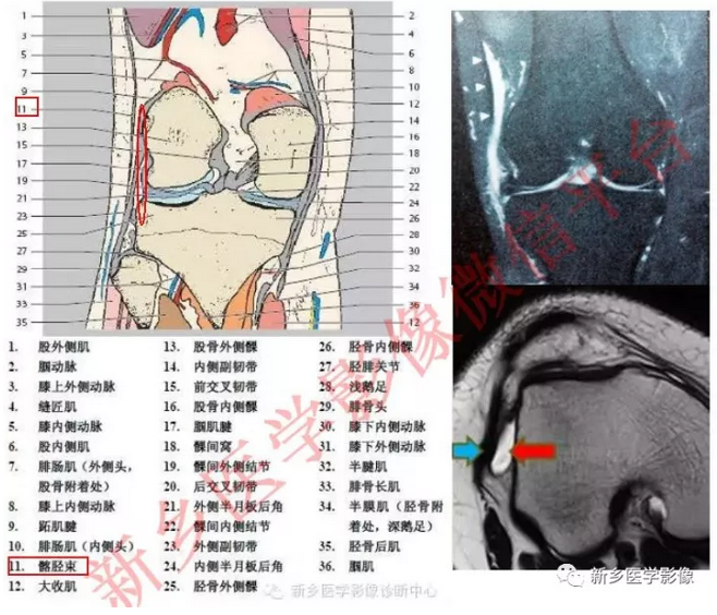 髂胫束指点与骨之间