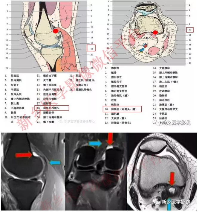 腓肠肌肌腱内侧头与关节囊之间