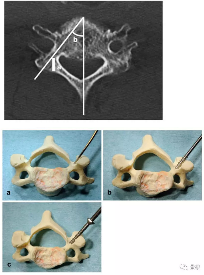 颈椎椎弓根开槽直视置钉技巧