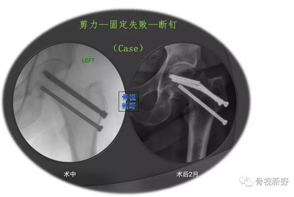 三枚空心拉力螺钉平行固定是股骨颈骨折最常见的内固定方法,但对于