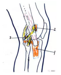 系统详解:外翻膝tka的手术技巧