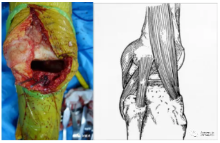 (iliotibial tract,itb 外侧副韧带(lcl 后外侧关节囊 膎肌腱(pop)