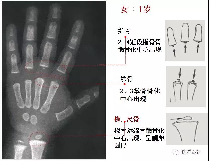 值得收藏的骨龄图谱!方便随时对照!