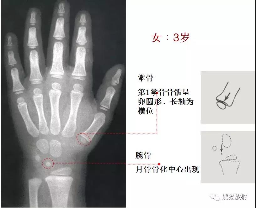 值得收藏的骨龄图谱!方便随时对照!