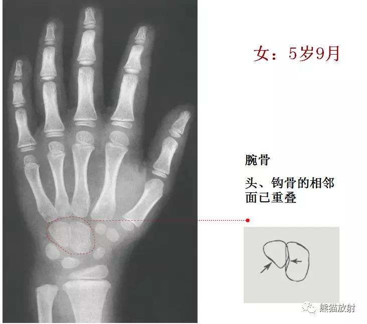 值得收藏的骨龄图谱!方便随时对照!