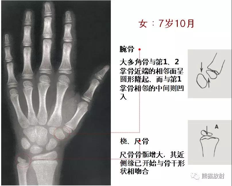 值得收藏的骨龄图谱!方便随时对照!