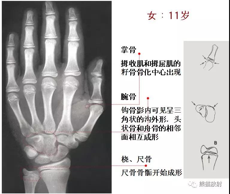 提前:骨龄比生活年龄大1岁以上; 延迟:骨龄比生活年龄小1岁以上