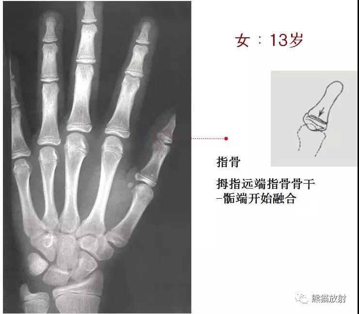 值得收藏的骨龄图谱!方便随时对照!