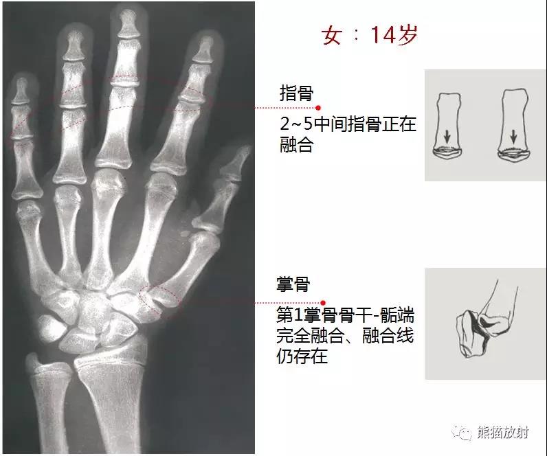 值得收藏的骨龄图谱!方便随时对照!