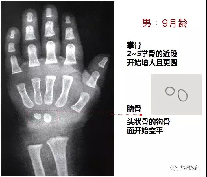 提前:骨龄比生活年龄大1岁以上; 延迟:骨龄比生活年龄小1岁以上