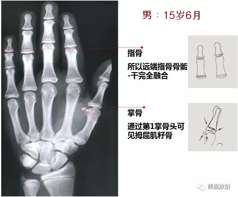 值得收藏的骨龄图谱!方便随时对照!