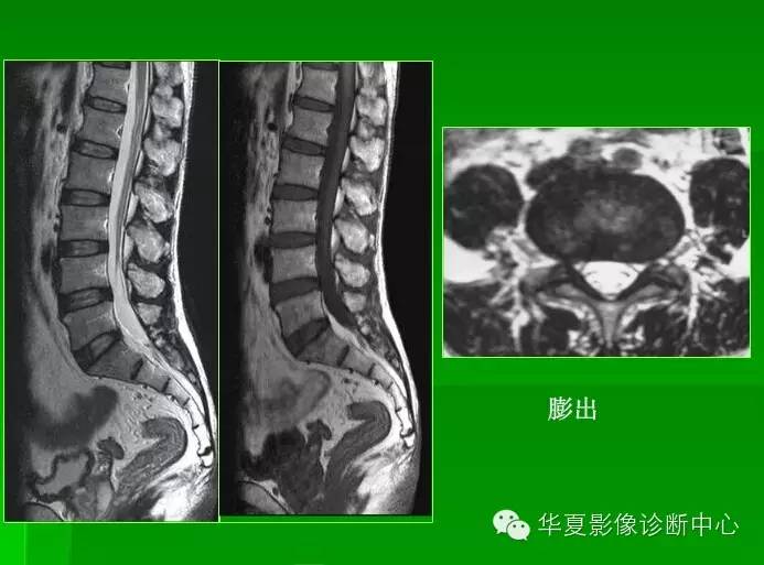 椎间盘的突出,膨出,脱出和髓核游离,你会鉴别吗?