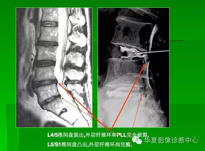 椎间盘的突出,膨出,脱出和髓核游离,你会鉴别吗?