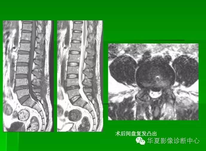 椎间盘的突出,膨出,脱出和髓核游离,你会鉴别吗?