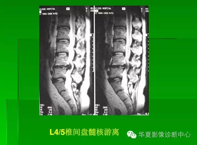 椎间盘的突出,膨出,脱出和髓核游离,你会鉴别吗?