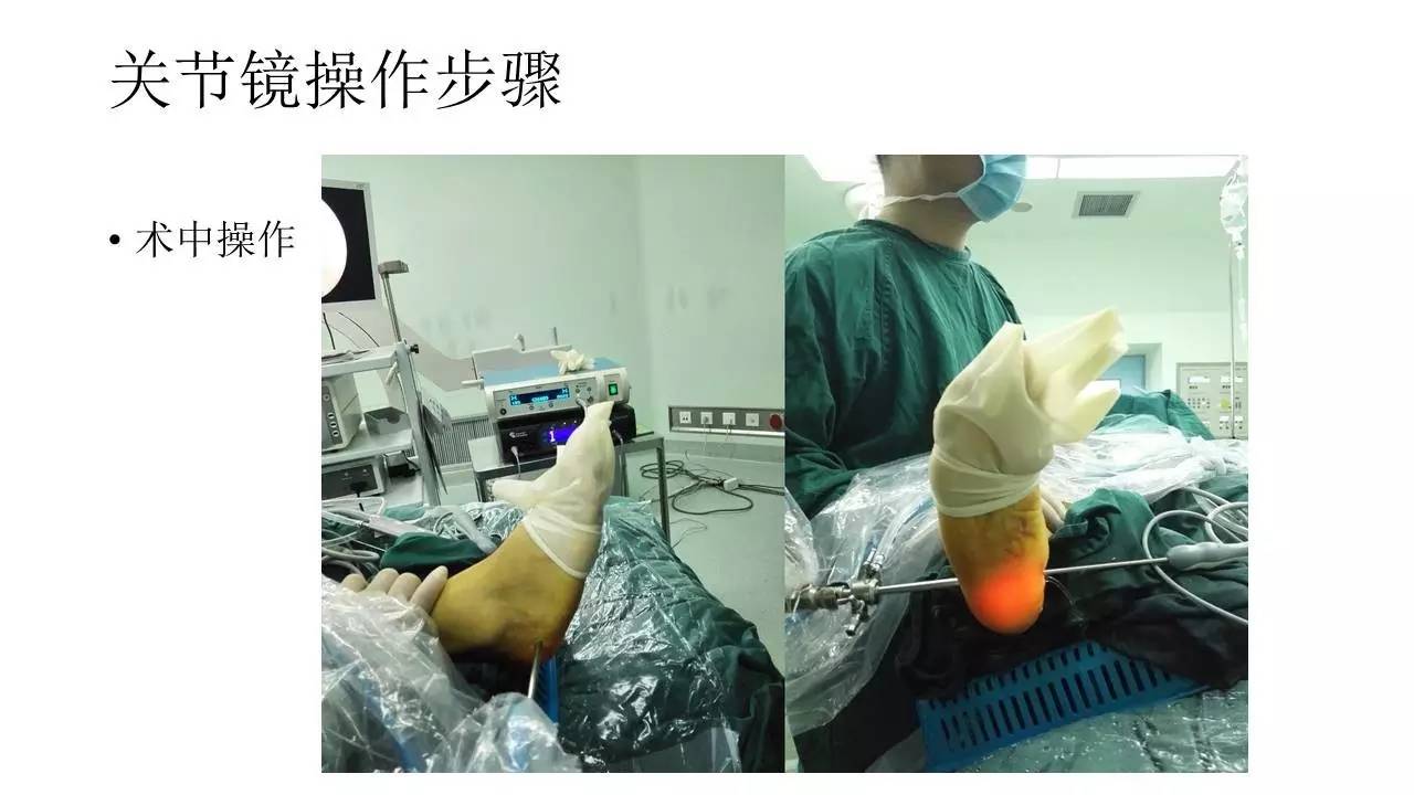 跖筋膜炎的关节镜治疗 --足跟痛 吕浩