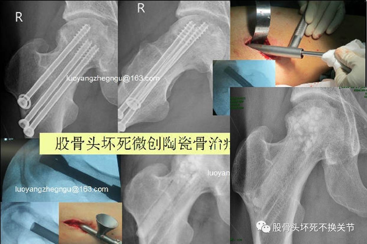 『8分钟创伤』难以闭合复位的股骨粗隆间骨折：不可复位的原因 - 上海开为医药科技有限公司--创伤、肢体矫形技术解决方案的专业服务商