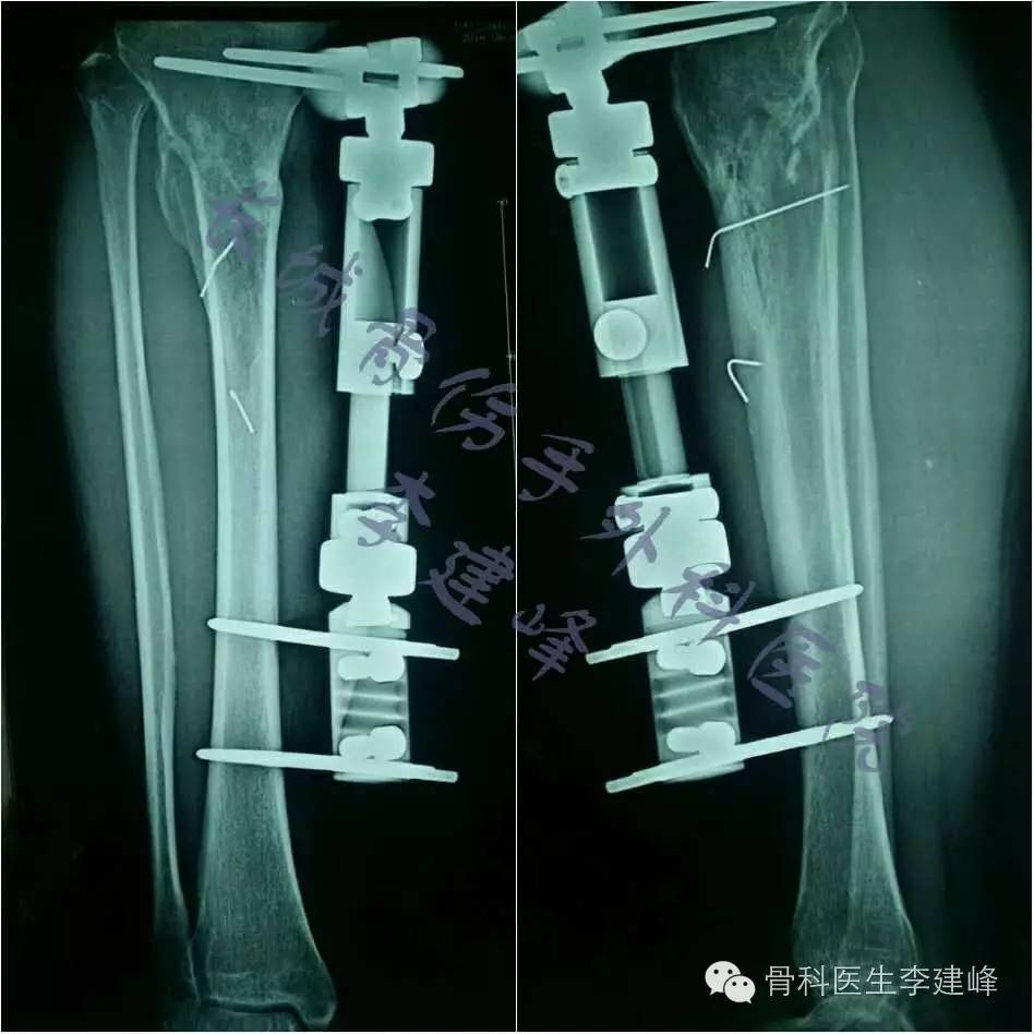 胫腓骨骨折的治疗方法 好医术早读文章 好医术 赋能医生守护生命