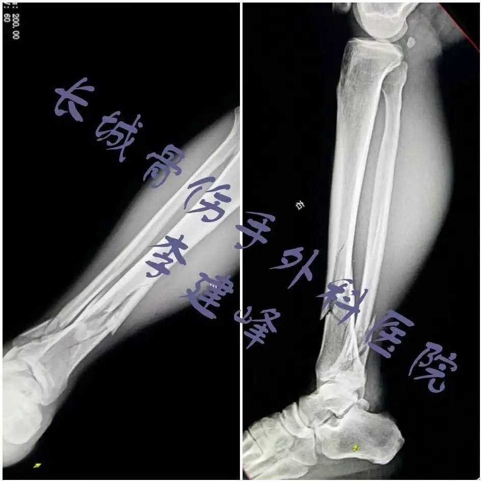 胫腓骨骨折的治疗方法 好医术早读文章 好医术 赋能医生守护生命