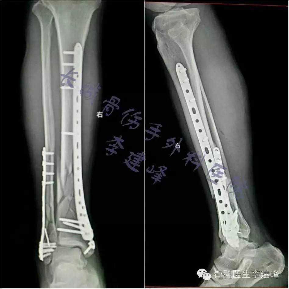 胫腓骨骨折的治疗方法 好医术早读文章 好医术 赋能医生守护生命