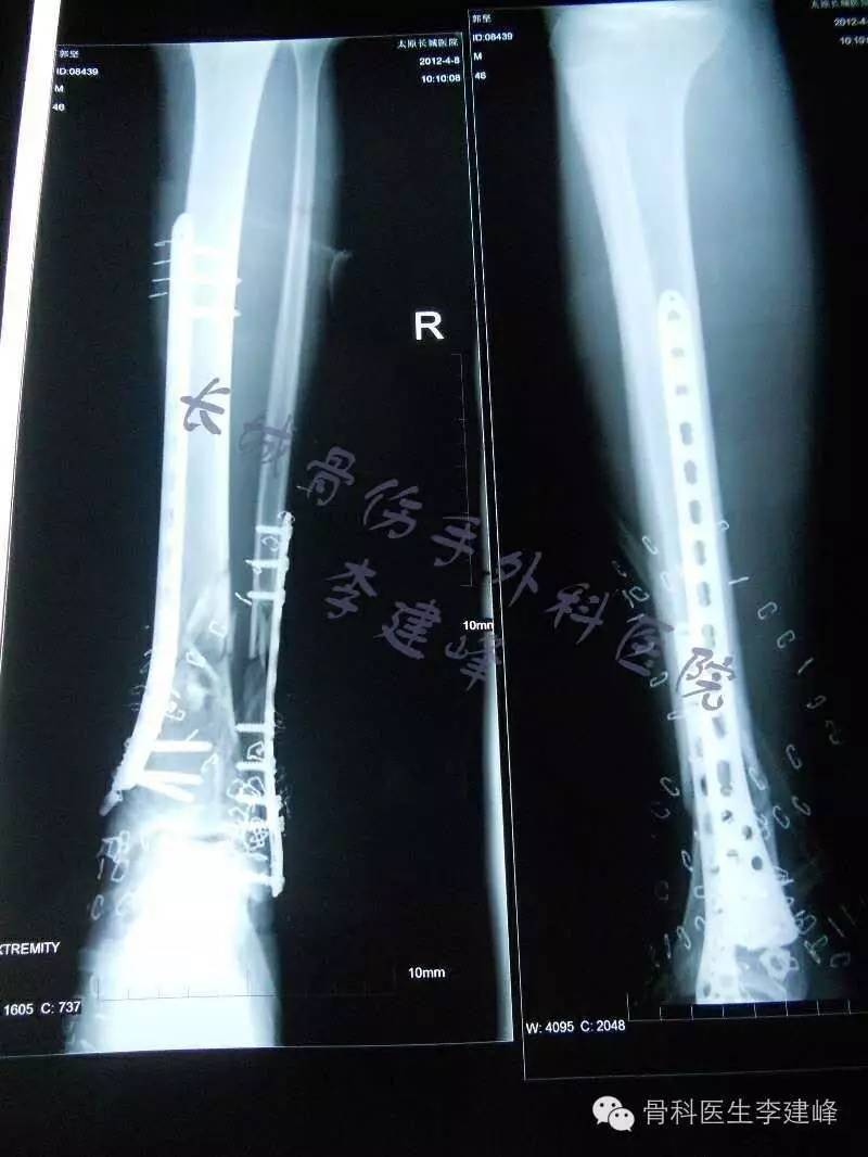 胫腓骨骨折的治疗方法 好医术早读文章 好医术 赋能医生守护生命