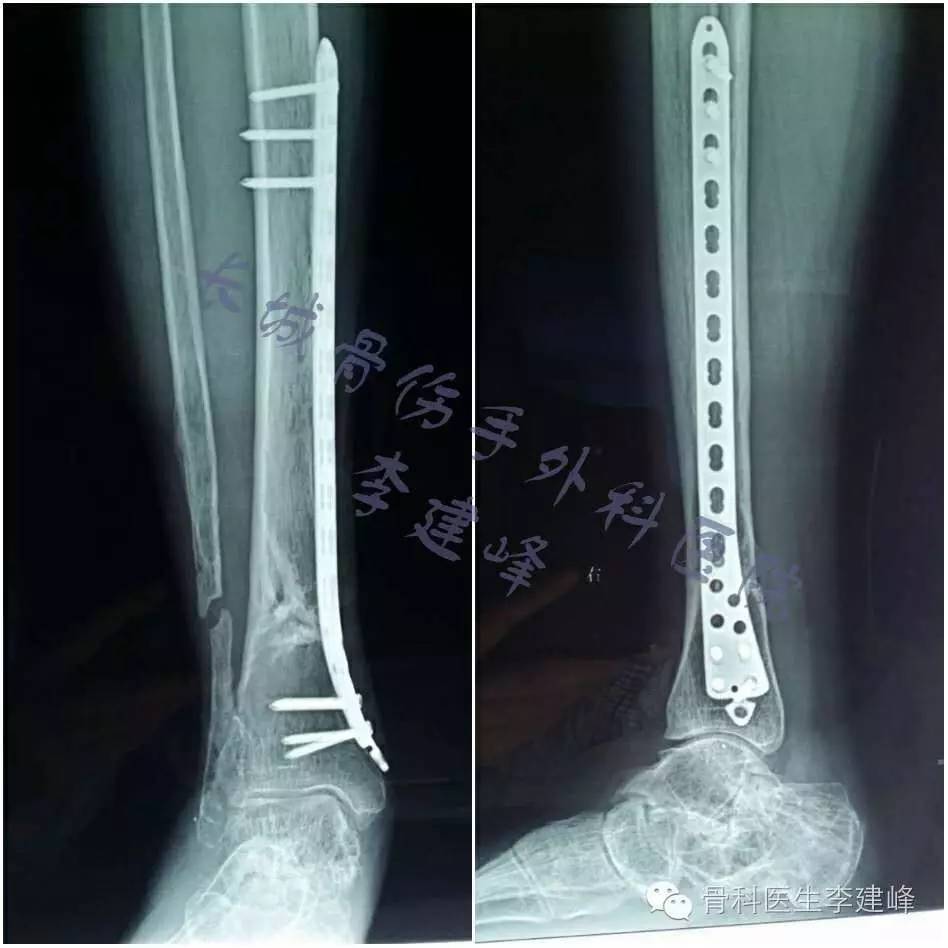胫腓骨骨折的治疗方法 好医术早读文章 好医术 赋能医生守护生命
