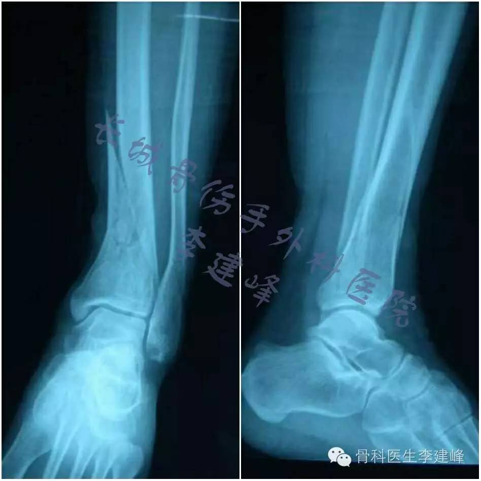 胫腓骨骨折的治疗方法 好医术早读文章 好医术 赋能医生守护生命