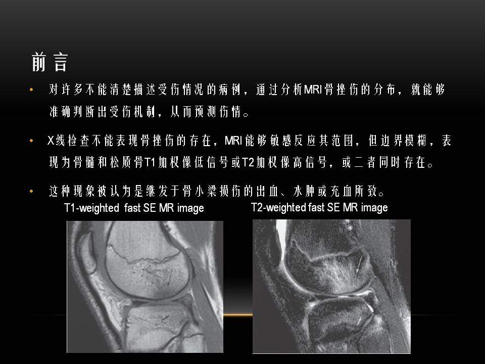 膝关节骨挫伤的分类及特点 好医术早读文章 好医术 赋能医生守护生命