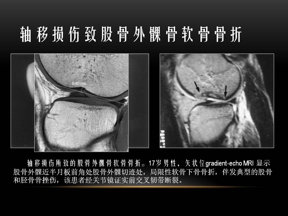 膝关节骨挫伤的分类及特点 好医术早读文章 好医术 赋能医生守护生命