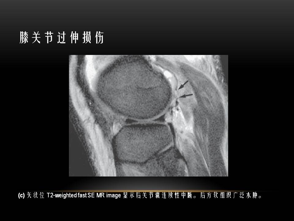 膝关节骨挫伤的分类及特点 好医术早读文章 好医术 赋能医生守护生命