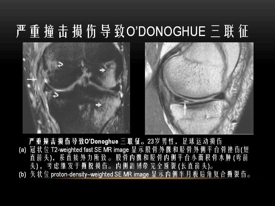 膝关节骨挫伤的分类及特点