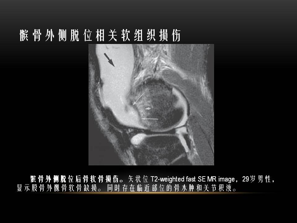 膝关节骨挫伤的分类及特点 好医术早读文章 好医术 赋能医生守护生命