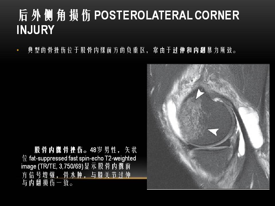 膝关节骨挫伤的分类及特点 好医术早读文章 好医术 赋能医生守护生命