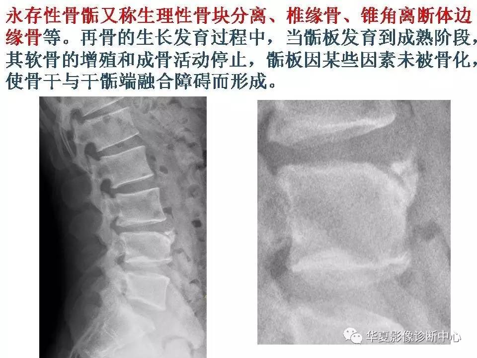 籽骨、副骨及永存骨骺，请别再误诊！