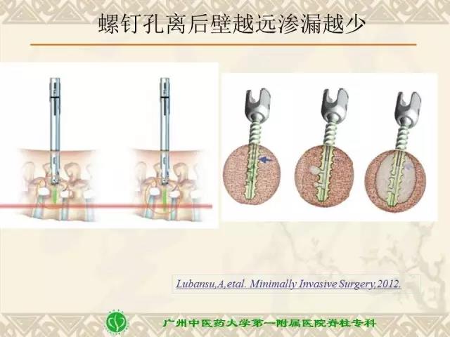 骨水泥椎弓根螺钉强化技术的安全流程