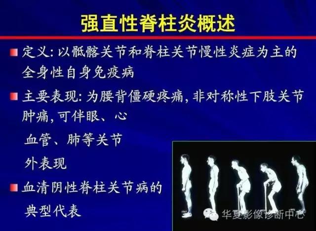 今天为各位分享的是强直性脊柱炎的临床诊疗,强脊现在越来越多地出现