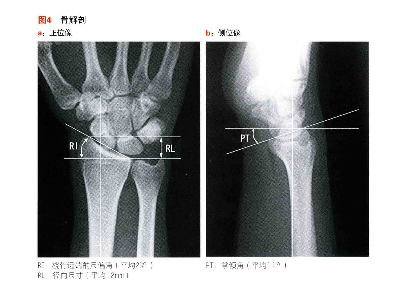 尺桡骨双骨折锁定钢板内固定手术一例 - 病例中心(诊疗助手) - 爱爱医医学网