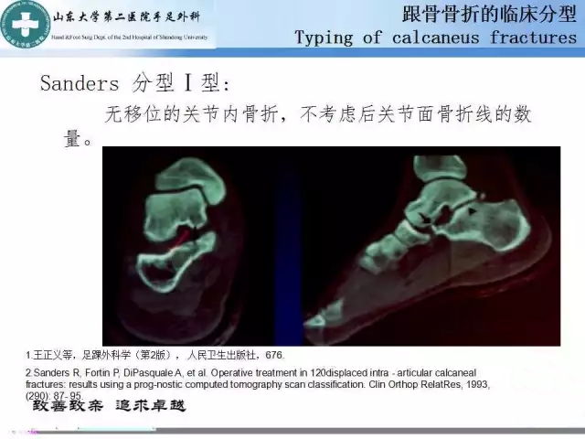 跟骨骨折的临床分型与图解 - 好医术早读文章 - 好医术-赋能医生守护生命