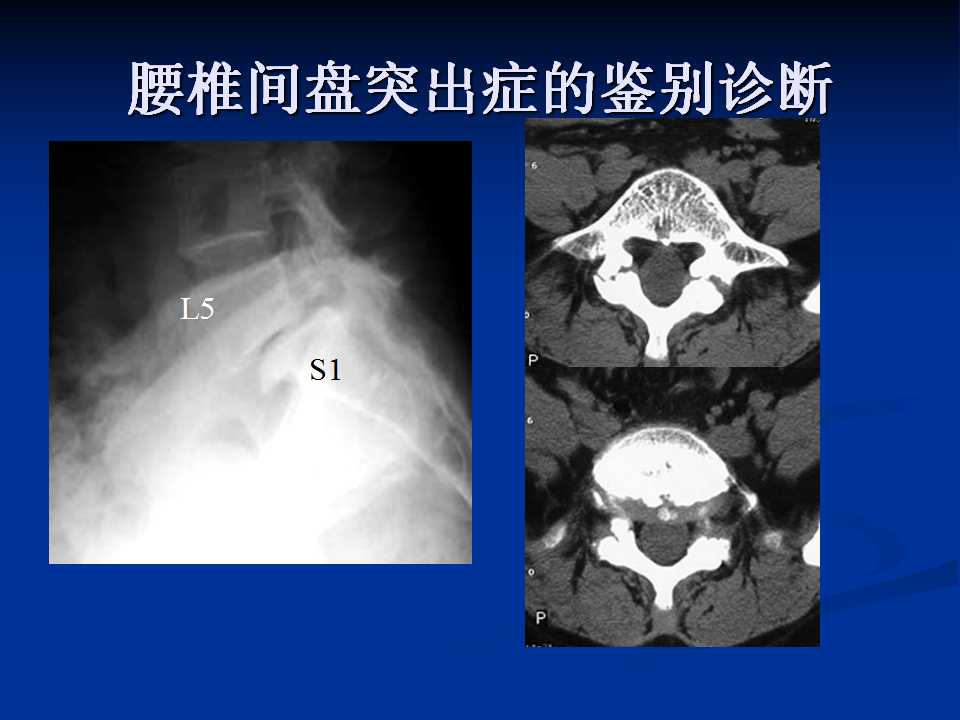 腰椎间盘突出症的鉴别诊断要点 好医术早读文章 好医术 赋能医生守护生命