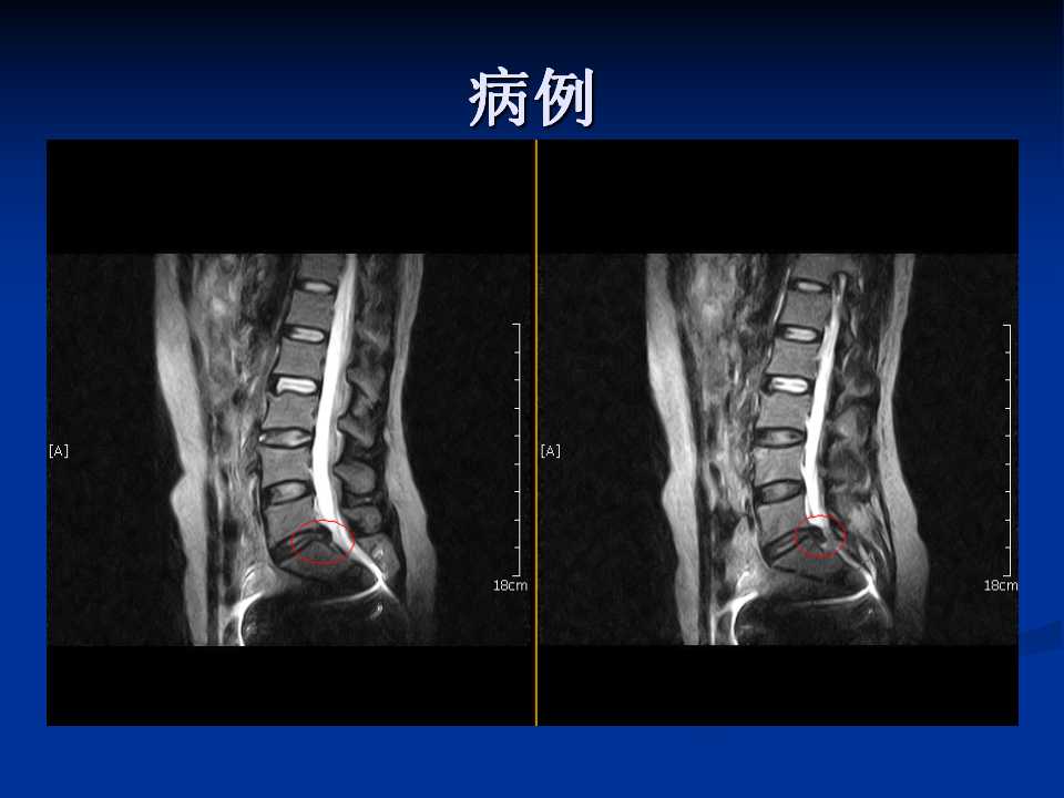 腰椎间盘突出症的鉴别诊断要点 好医术早读文章 好医术 赋能医生守护生命