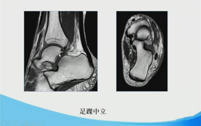 足踝部mri的解剖及诊断要点 好医术早读文章 好医术 赋能医生守护生命