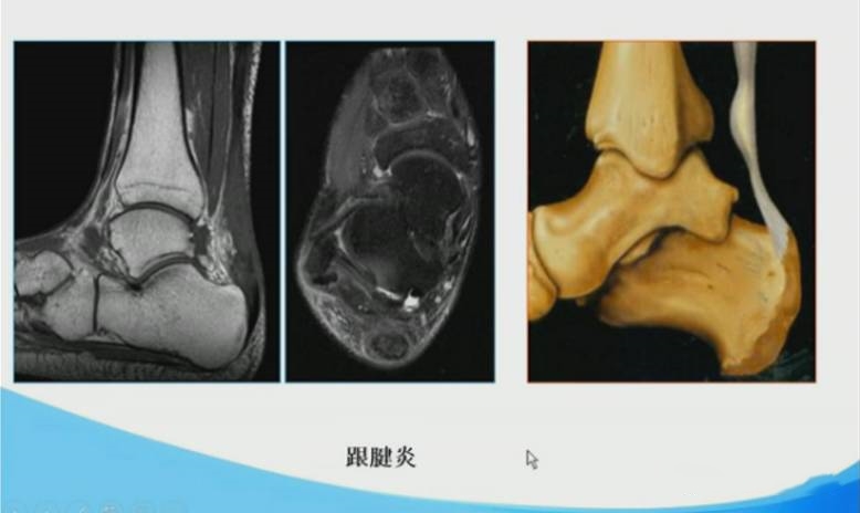 足踝部mri的解剖及诊断要点 好医术早读文章 好医术 赋能医生守护生命