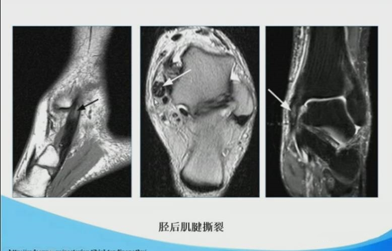 足踝部mri的解剖及诊断要点 好医术早读文章 好医术 赋能医生守护生命